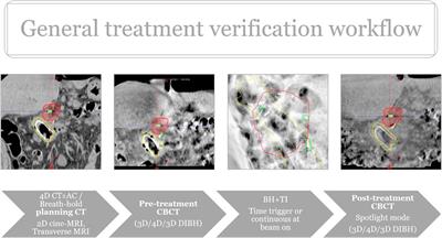 Pancreatic SABR using peritumoral fiducials, triggered imaging and breath-hold